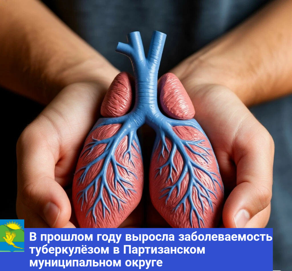 Заболеваемость туберкулезом выросла в Партизанском муниципальном округе в прошлом году.